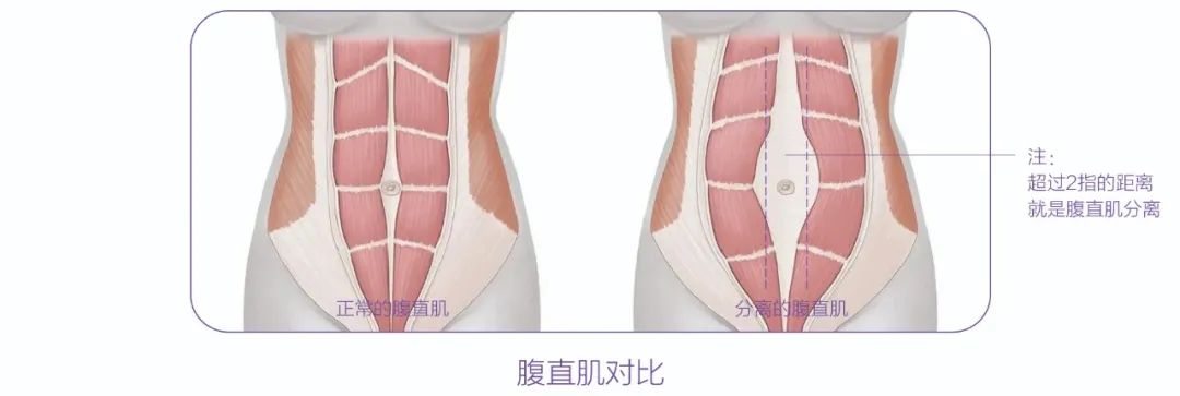 生完孩子就“分开”?!产后妈妈 你得这样“自救”(图4) 生完孩子就“分开”?!产后妈妈 你得这样“自救”(图4)